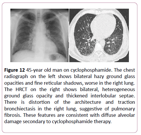 clinical-radiology-case-reports-cyclophosphamide