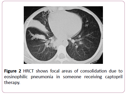 clinical-radiology-case-reports-eosinophilic