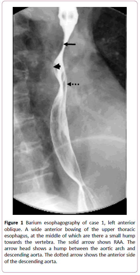 clinical-radiology-case-reports-esophagography
