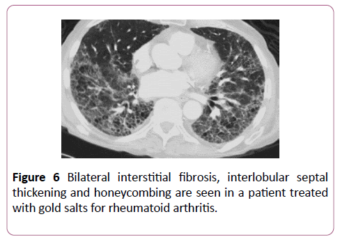 clinical-radiology-case-reports-fibrosis