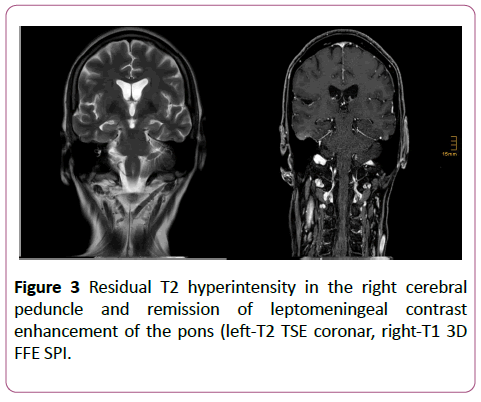 clinical-radiology-case-reports-hyperintensity