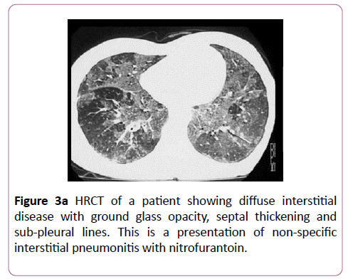clinical-radiology-case-reports-eosinophilic