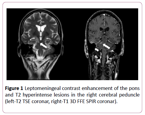 clinical-radiology-case-reports-leptomeningeal