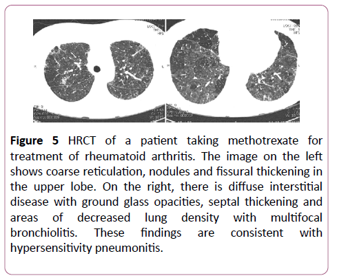 clinical-radiology-case-reports-methotrexate