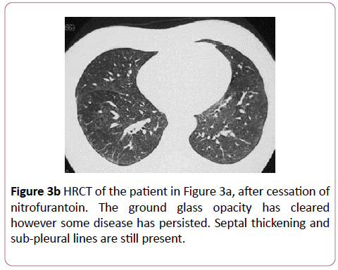 clinical-radiology-case-reports-nitrofurantoin