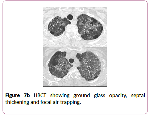 clinical-radiology-case-reports-opacity