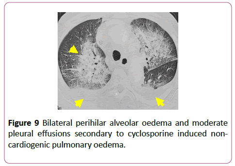 clinical-radiology-case-reports-perihilar