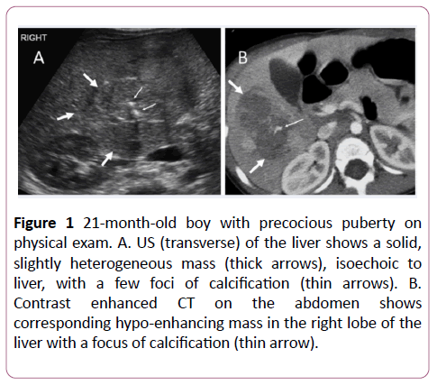 clinical-radiology-case-reports-puberty