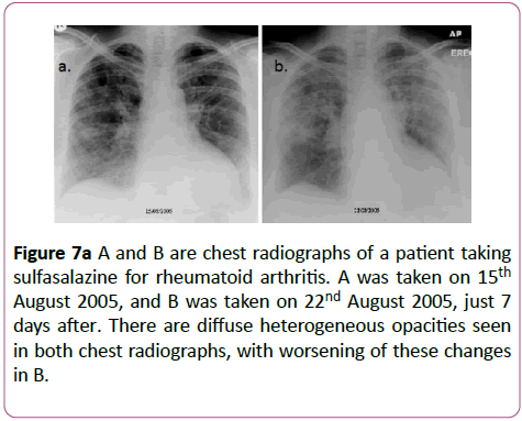 clinical-radiology-case-reports-rheumatoid