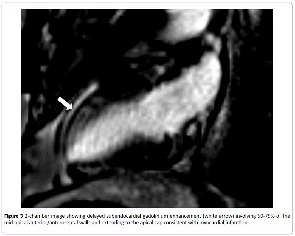 clinical-radiology-case-reports-subendocardial