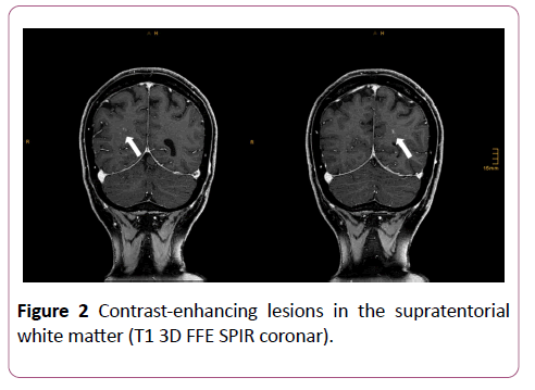 clinical-radiology-case-reports-supratentorial