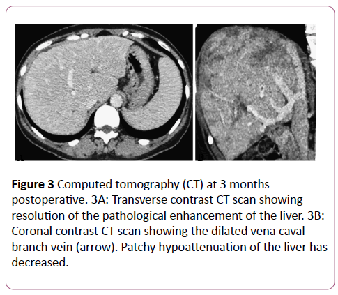 clinical-radiology-case-reports-tomography