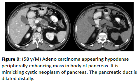 clinical-radiology-cystic-neoplasm