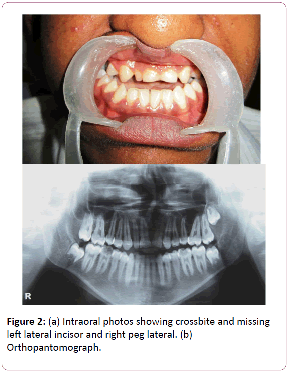 congenital-diseases-Intraoral-photos