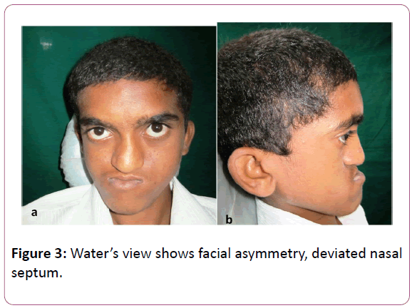 congenital-diseases-deviated-nasal