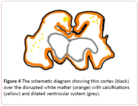 congenital-diseases-dilated-ventricular-system