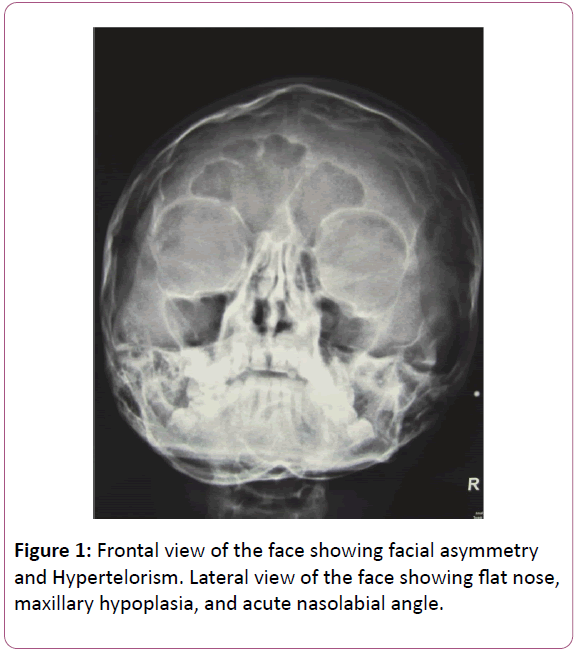 congenital-diseases-facial-asymmetry