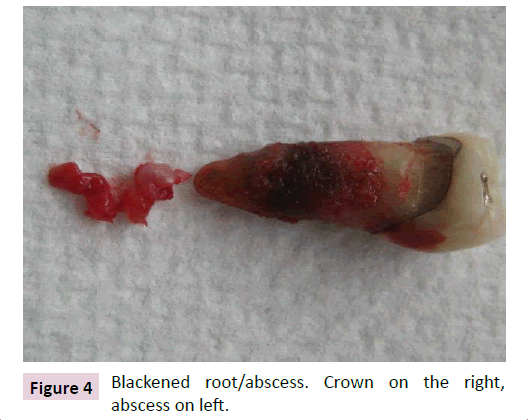 dental-craniofacial-research-Blackened-root