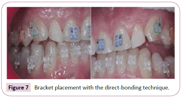 dental-craniofacial-research-Bracket-placement-bonding