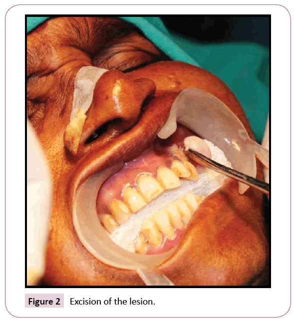 dental-craniofacial-research-Excision-lesion