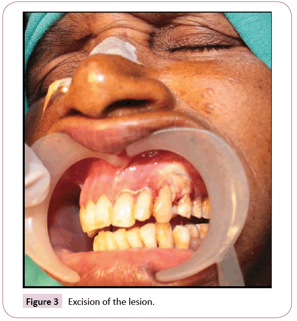 dental-craniofacial-research-Excision-lesion