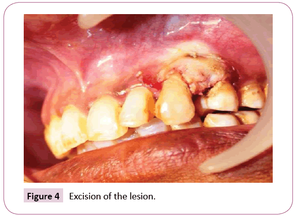 dental-craniofacial-research-Excision-lesion