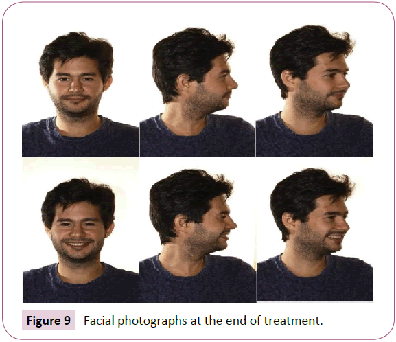 dental-craniofacial-research-Facial-photographs-treatment