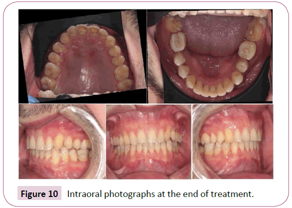 dental-craniofacial-research-Intraoral-photographs-treatment
