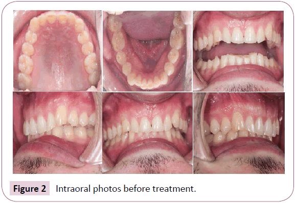 dental-craniofacial-research-Intraoral-photos-treatment