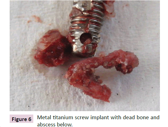 dental-craniofacial-research-Metal-titanium
