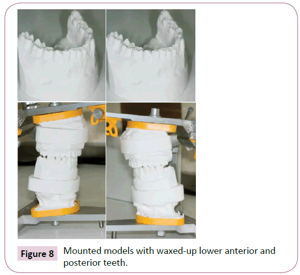 dental-craniofacial-research-Mounted-waxed-up-anterior