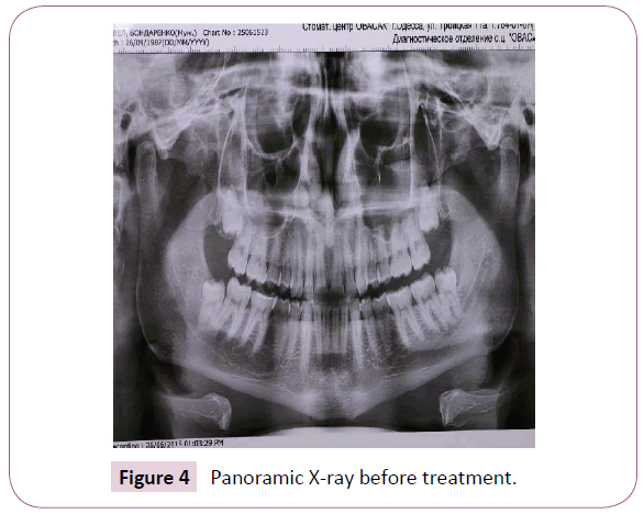 dental-craniofacial-research-Panoramic-X-ray-treatment