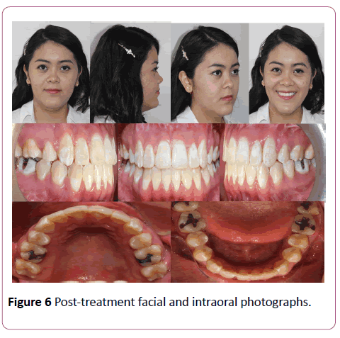 dental-craniofacial-research-Post-treatment
