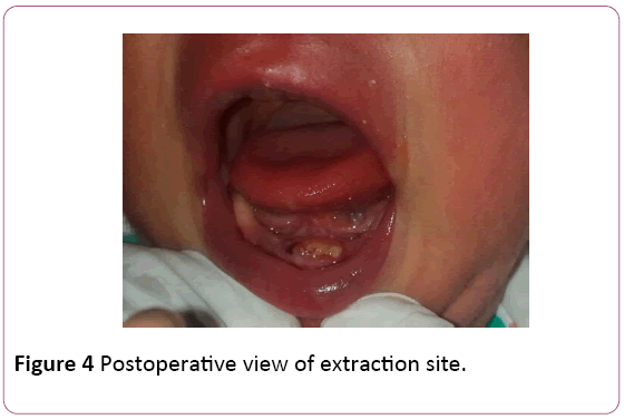 dental-craniofacial-research-Postoperative-extraction