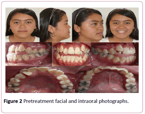 dental-craniofacial-research-Pretreatment-facial