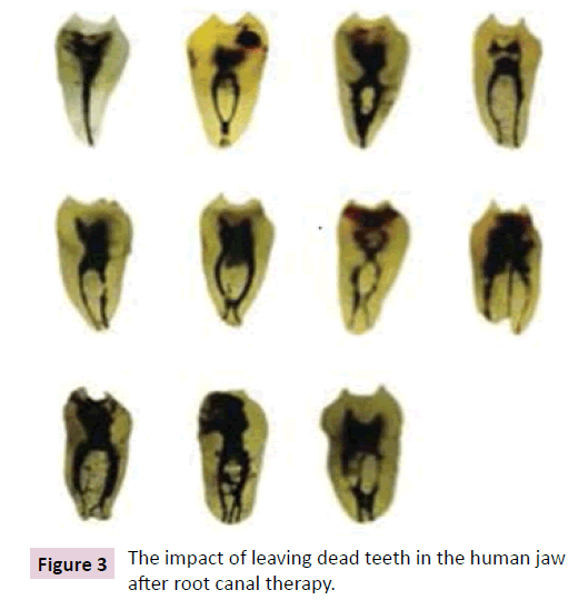 dental-craniofacial-research-dead-teeth