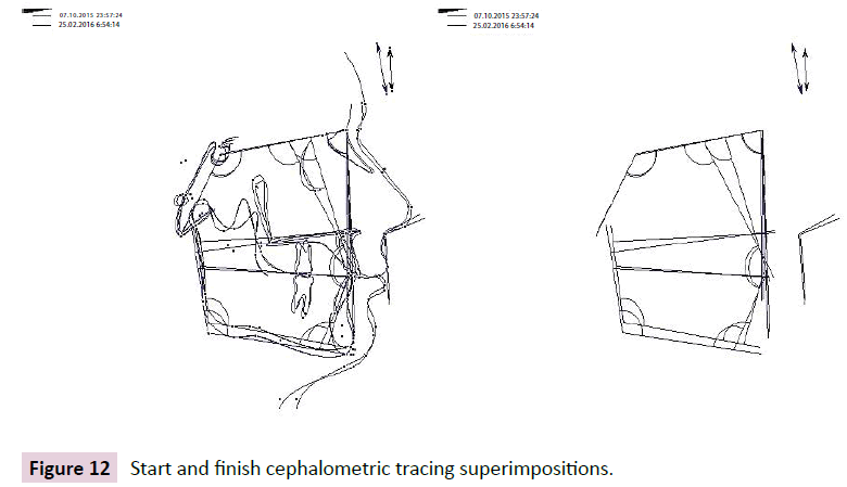 dental-craniofacial-research-finish-cephalometric-superimpositions