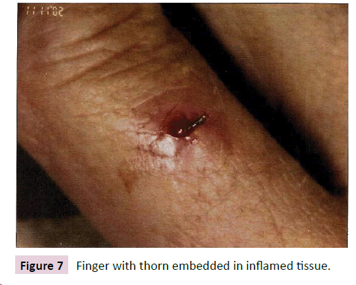 dental-craniofacial-research-inflamed-tissue