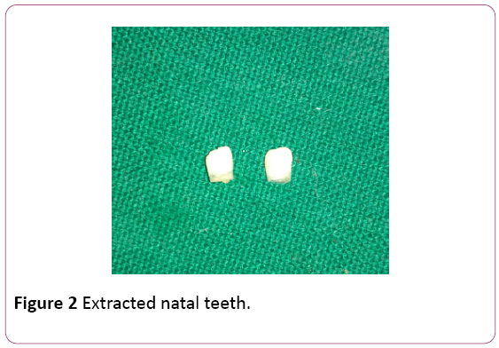 dental-craniofacial-research-natal-teeth