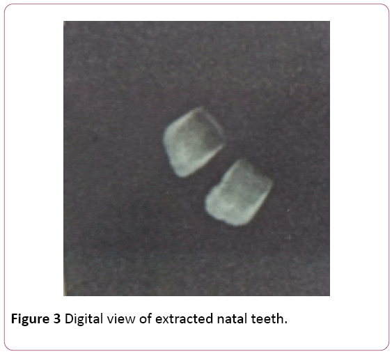 dental-craniofacial-research-natal-teeth