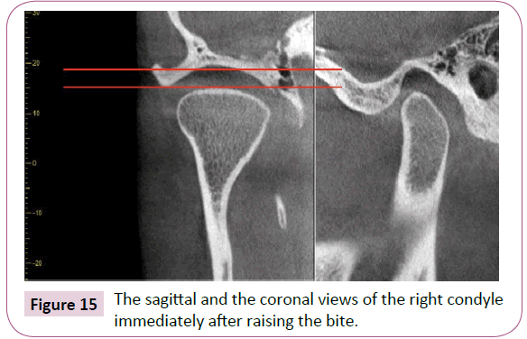 dental-craniofacial-research-sagittal-condyle-raising