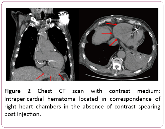 emergency-internal-medicine-Intrapericardial-hematoma