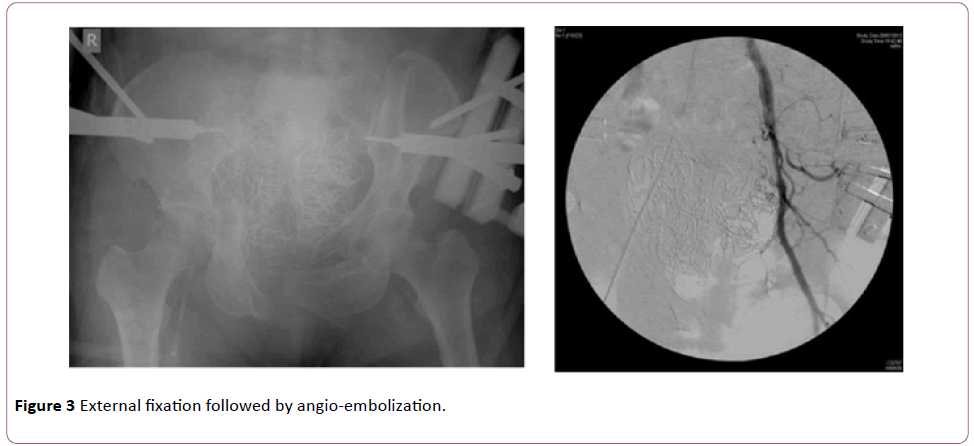 emergency-trauma-External-fixation