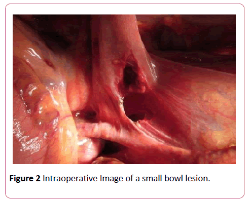 emergency-trauma-care-Intraoperative-bowl-lesion