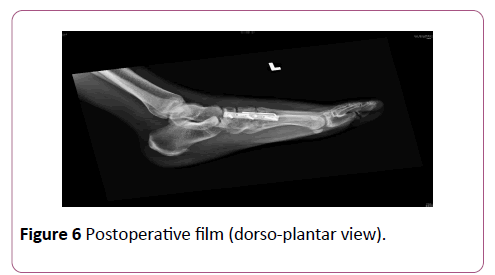 emergency-trauma-care-Postoperative-dorso-plantar