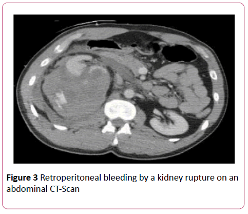 emergency-trauma-care-Retroperitoneal-bleeding