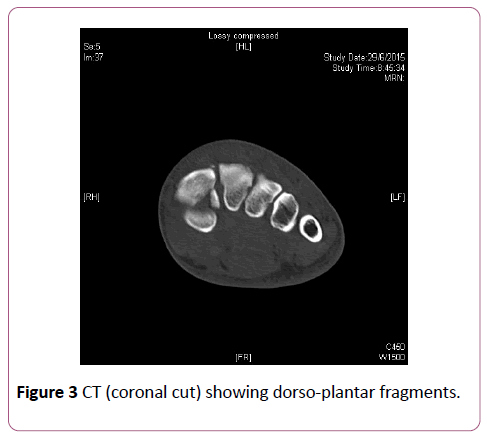 emergency-trauma-care-dorso-plantar-fragments