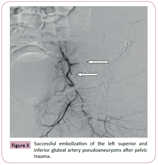 emergency-trauma-care-embolization