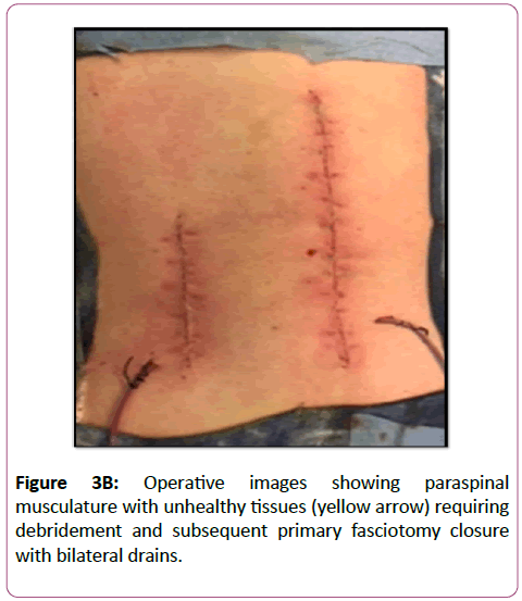 emergency-trauma-care-fasciotomy