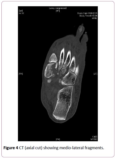 emergency-trauma-care-medio-lateral-fragments